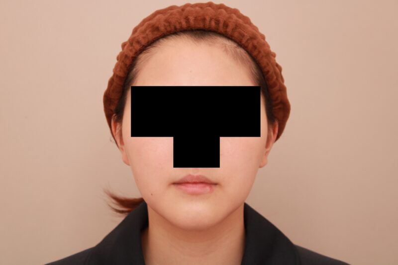 お顔の脂肪吸引 術後3ヵ月の経過