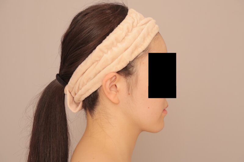 お顔の脂肪吸引 術後3ヵ月の経過