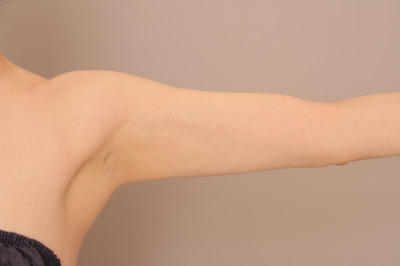 二の腕・方の脂肪吸引 術後6カ月の経過