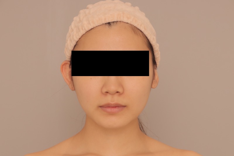 22歳　頬＋顎下　細身の症例