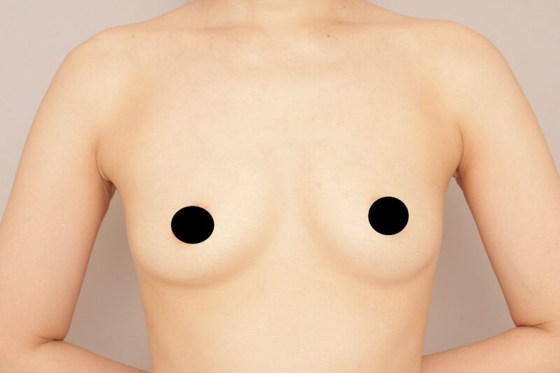 ベイザー脂肪吸引（1ヵ月経過：35）の術前写真