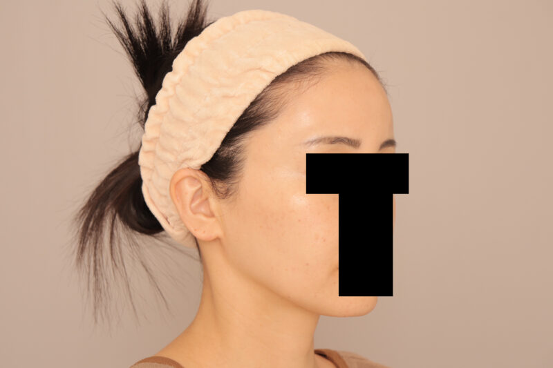 おでここめかみの脂肪注入でますますかわいらしい印象に♡