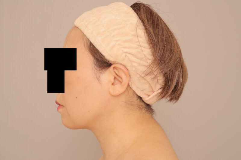 54歳頬顎脂肪吸引モニター様♡半年後