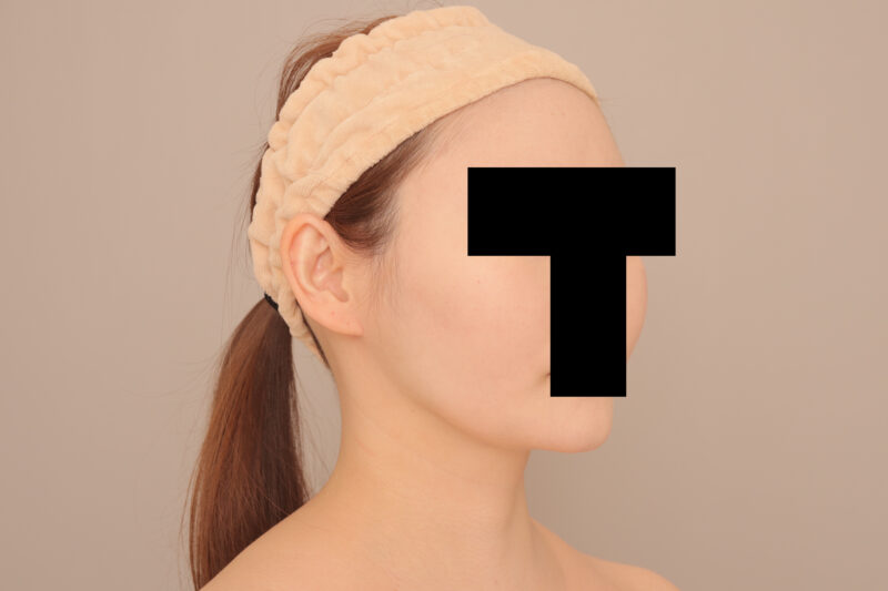 ほぼ全身させて頂いているモニター様の頬顎脂肪吸引半年後♡