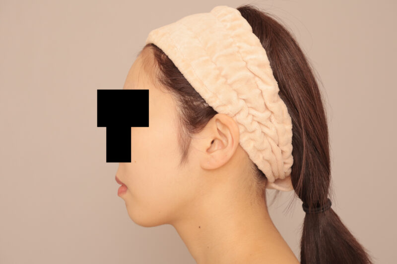 頬顎脂肪吸引でよりシュッとしたフェイスラインに♡3か月後