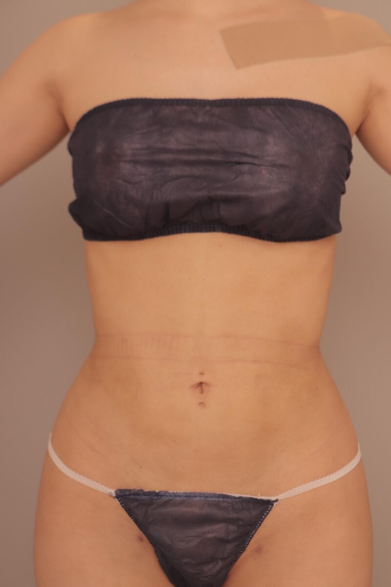 ブラジリアンバットリフト&太腿全周お尻膝吸引でバービー体型を目指したモニター様1ヶ月半後♡