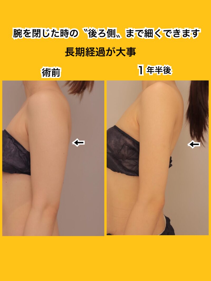 長期経過をお見せします。腕を閉じた時の〝後ろ側まで細くできます。〟～25歳156cm48kg上腕肩脇肉700cc吸引後１年半～