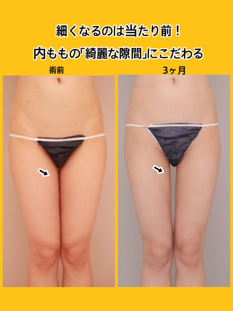 ベイザー脂肪吸引（3か月経過：26）の術前写真