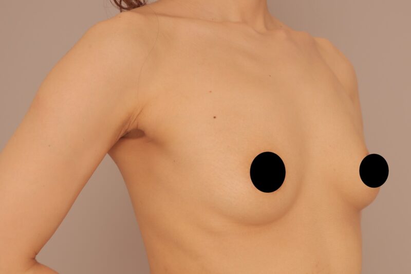 ベイザー脂肪吸引（1ヶ月経過：39）の術前写真