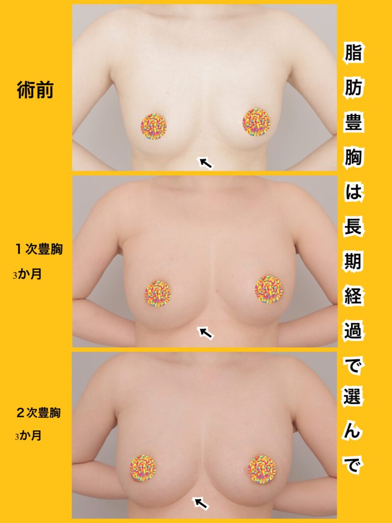 時系列でお見せします。お胸横の〝曲線美〟までこだわる吉江式~40歳162cm56kg脂肪豊胸(CRF豊胸)1次豊胸後3か月、2次豊胸後3か月~