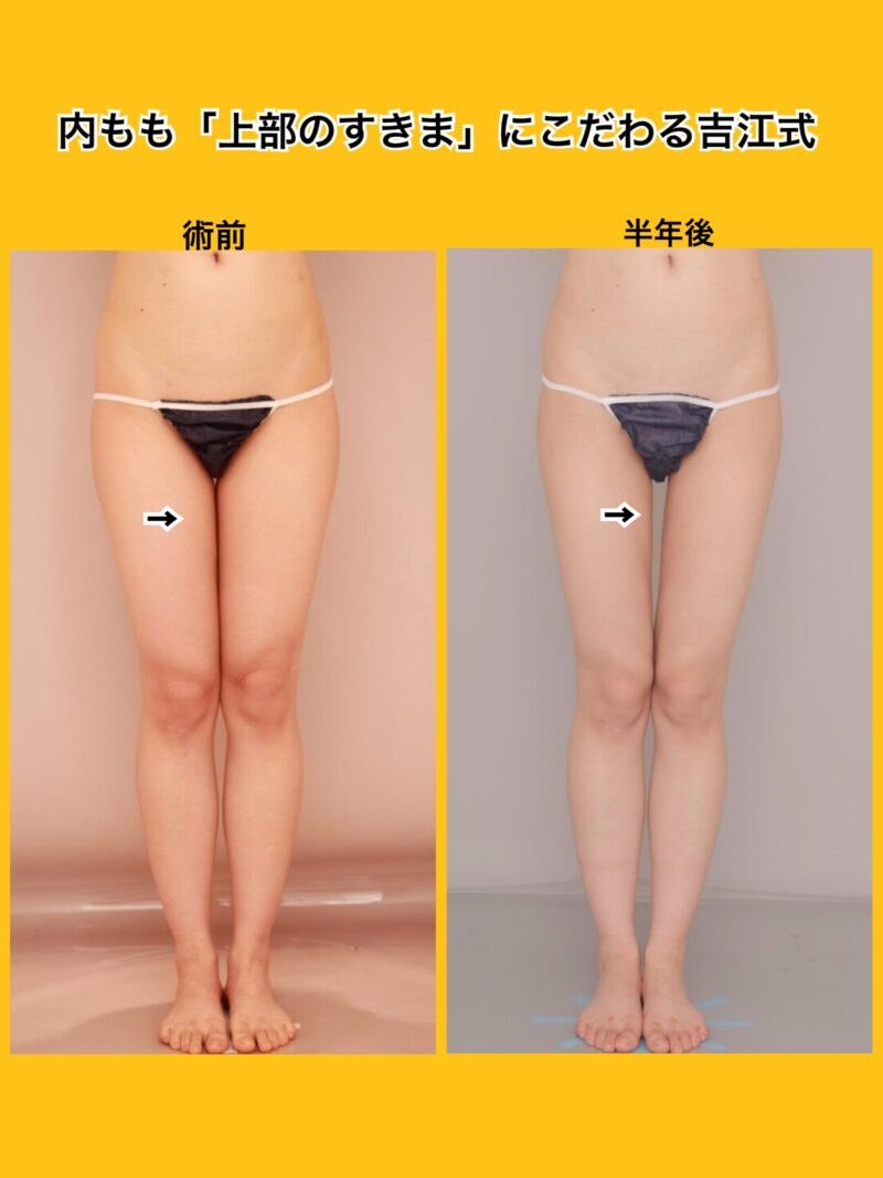 ベイザー脂肪吸引(半年経過:26)の術後写真