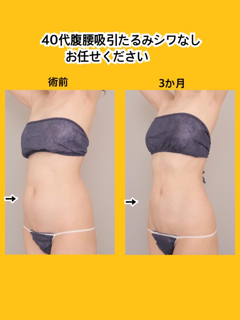 40代腹腰吸引たるみシワほぼなしお任せください。～45歳160cm50kg腹部全体胸下腰1950cc吸引後3ヶ月～
