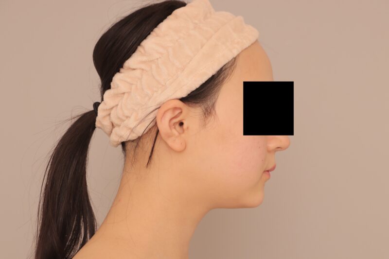 ベイザー脂肪吸引（3か月経過：22）の術前写真