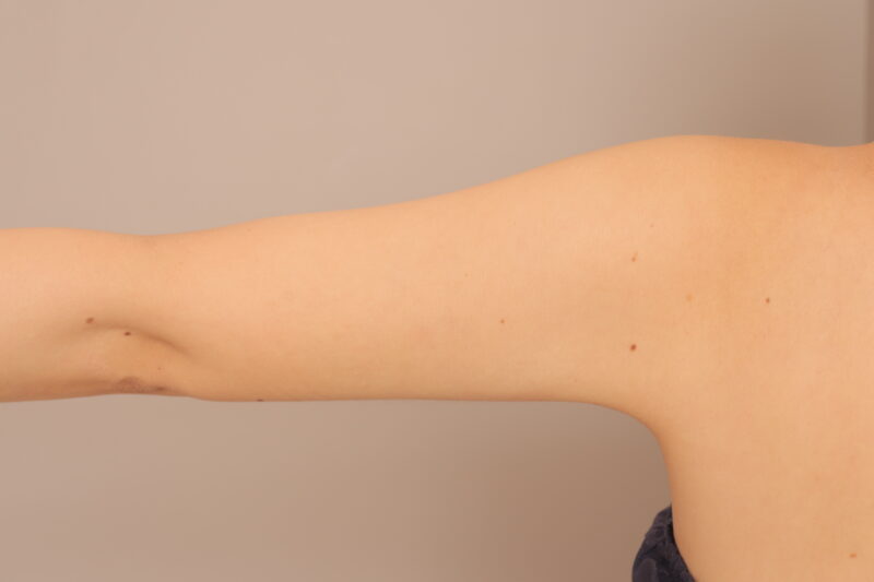 二の腕、肩の脂肪吸引で二の腕の印象を変えましょう!モニター様3か月後