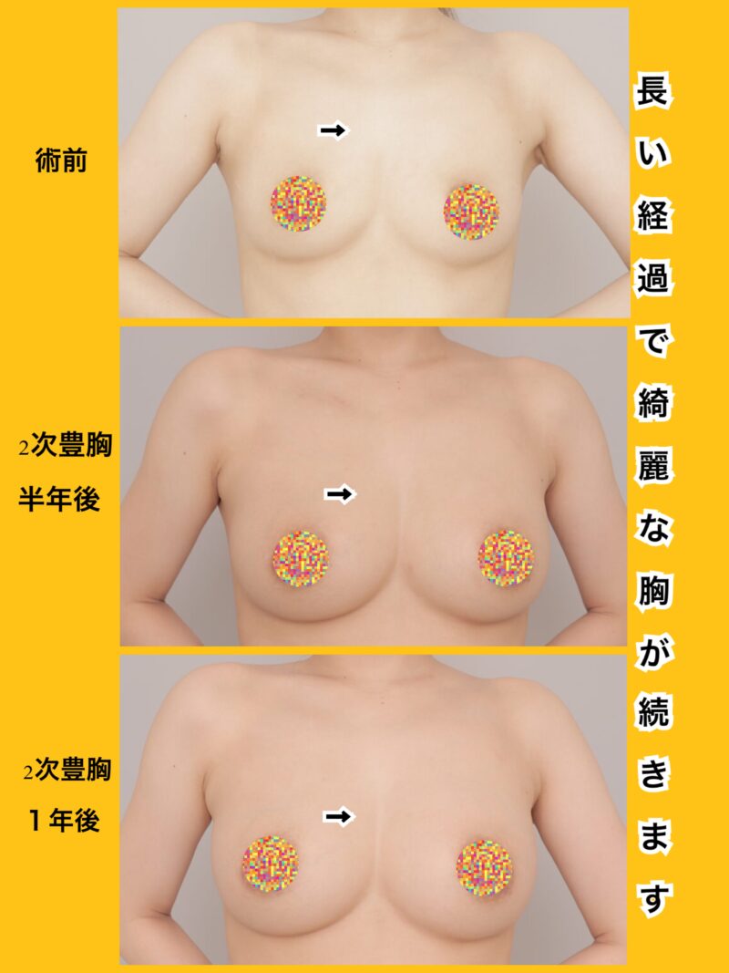 脂肪豊胸大きさはずっと続きます。長期経過が一番大事です。～25歳155cm47kg脂肪豊胸（CRFバスト）600cc注入後時系列2回目後（凍結脂肪使用）半年、1年後～