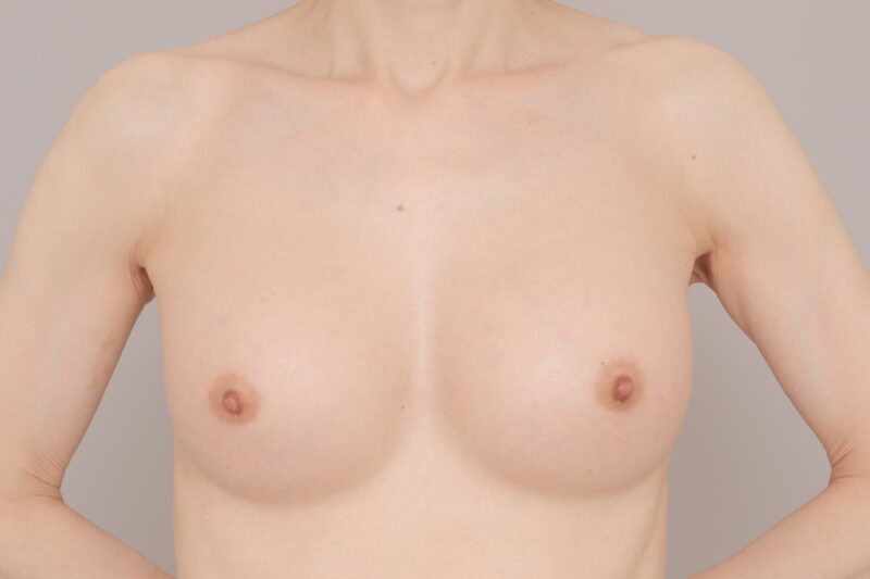 綺麗な形にこだわる吉江式。お任せください。～57歳159cm46kg脂肪豊胸（CRFバスト）二次豊胸１か月後～