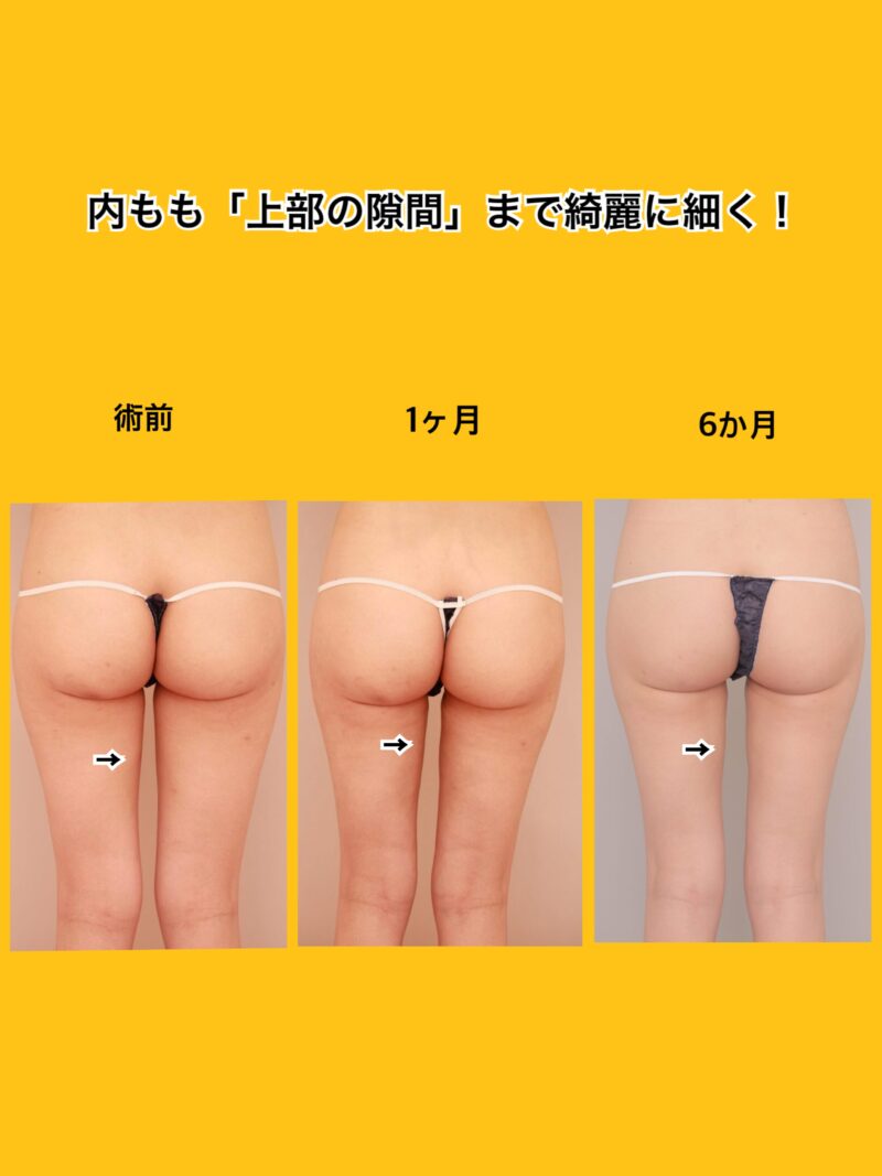 ベイザー脂肪吸引（時系列経過：25）の術後写真