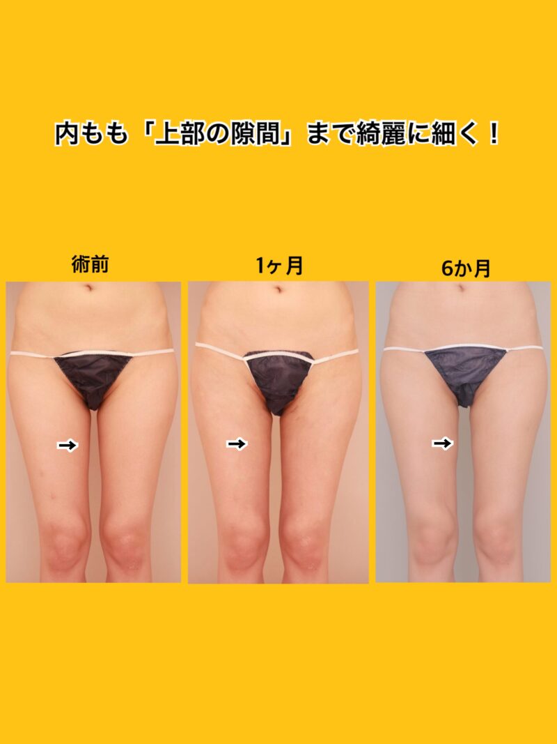 ベイザー脂肪吸引（時系列経過：25）の術前写真
