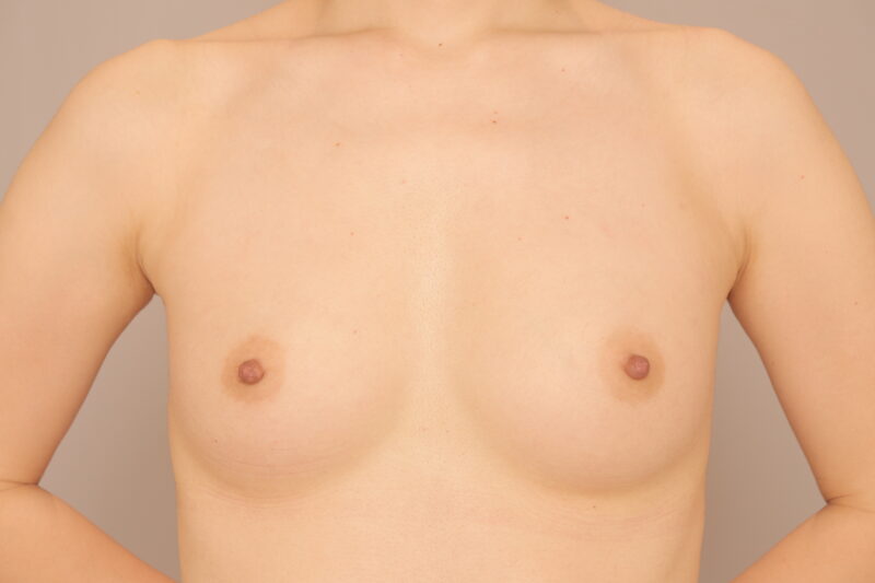 ママさんのコンデンスリッチ豊胸半年後♪