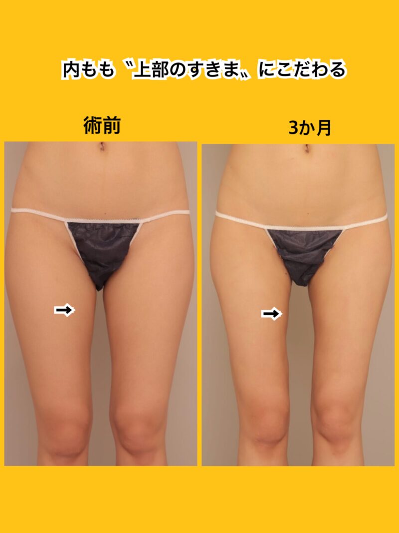 内もも〝上部のすき間〟大事です。ここにこだわりがあります。    ～29歳165cm55kg大腿全周膝臀部1700cc吸引後時系列３ヶ月～