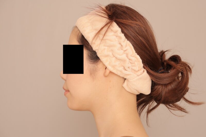 御顔の脂肪吸引 術後6カ月の経過