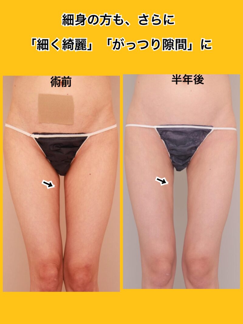 ベイザー脂肪吸引（半年後経過：23）の術前写真