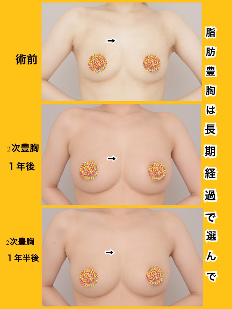 長期経過完全版！「本当に残るの？」→お任せください！長い経過がわかります！～25歳155cm47kg脂肪豊胸（CRFバスト）600cc注入後時系列2回目後1年後、1年半～