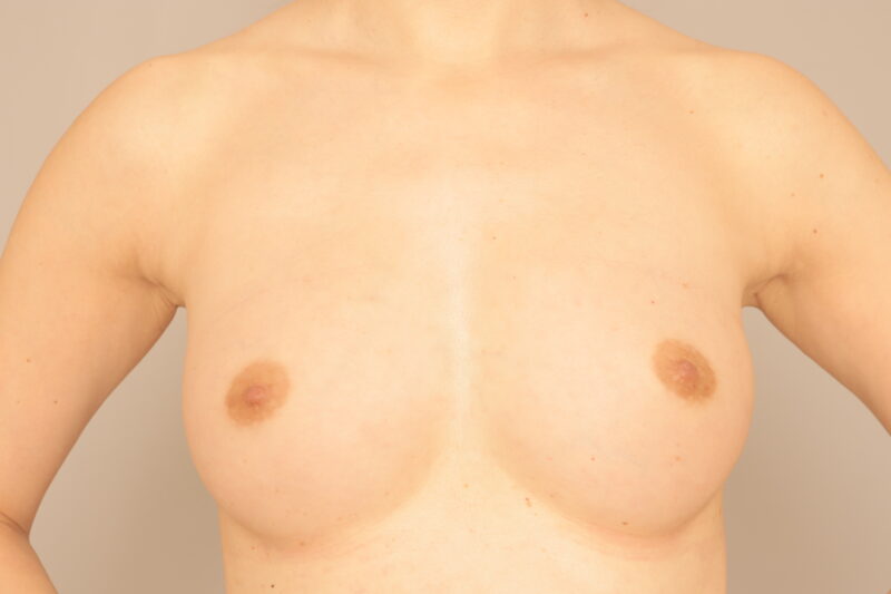 Ａ→Ｄカップに！大きく、綺麗に。“美”豊胸お任せください。～脂肪豊胸（CRF豊胸）２次豊胸後３ヶ月～