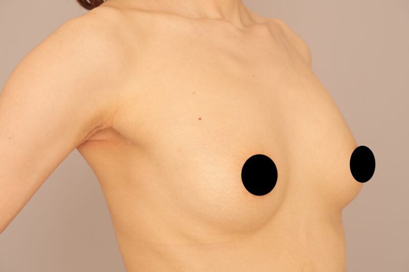 ベイザー脂肪吸引（1ヶ月経過：39）の術後写真