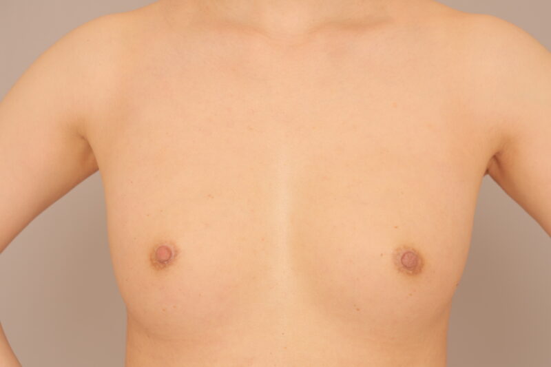 コンデンスリッチ豊胸のモニター様3年後♡