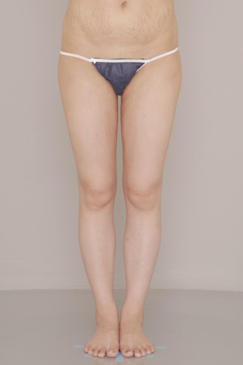 太ももの脂肪吸引 術後3か月の経過