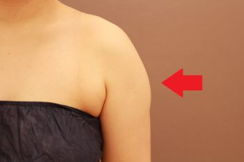二の腕の脂肪吸引 まとめ