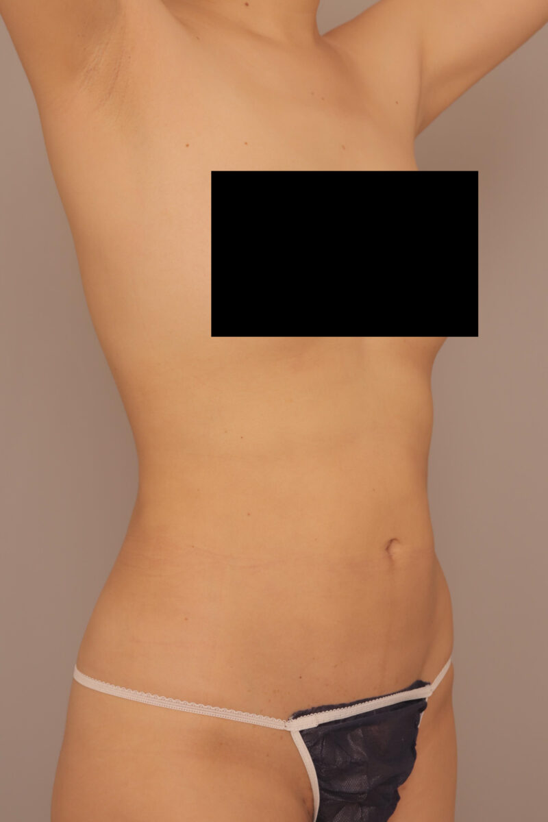 目指せ産前よりキレイ♡ママさんのお腹全体胸下腰の脂肪吸引半年後