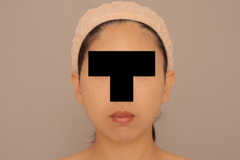 頬顎脂肪吸引でますますキレイなママさんに♡半年後