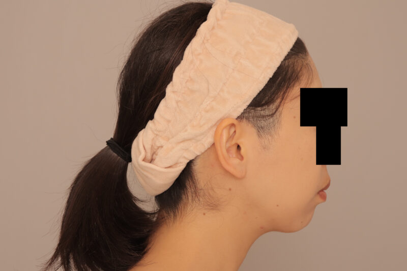 目指せママになってますますキレイ♡頬顎脂肪吸引半年後♫