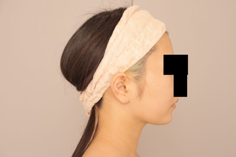 頬顎脂肪吸引&顎のヒアルロン酸で目指せ女優さんのフェイスライン♡③か月後