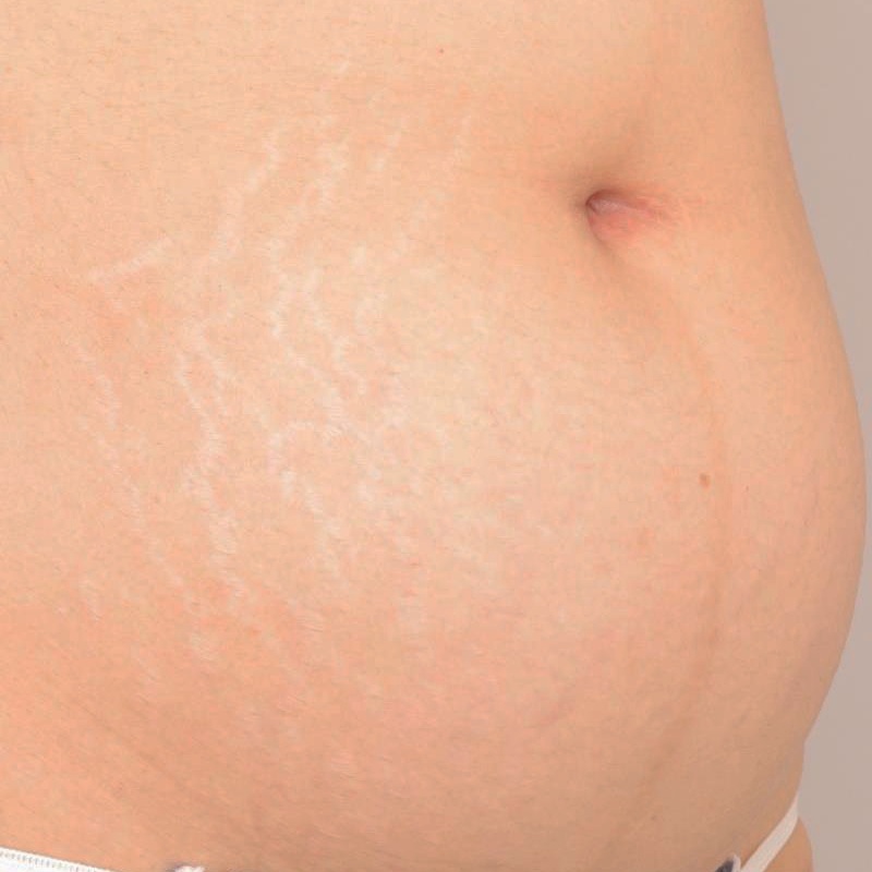 妊娠線や肉割れは脂肪吸引で治るか？　46歳　腹部＋胸下＋腰