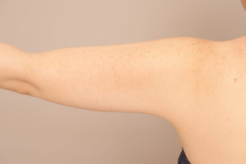 二の腕、肩の脂肪吸引でシルエット激変♡40代モニター様3か月後♫