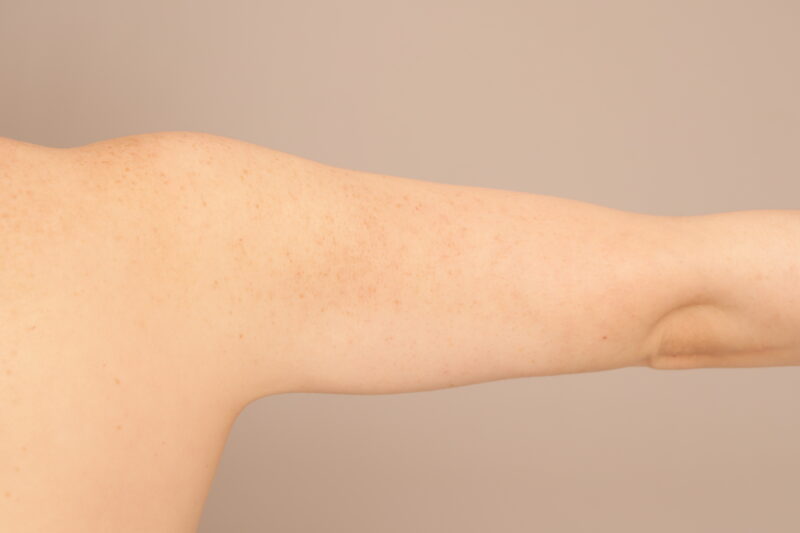 二の腕、肩の脂肪吸引でシルエット激変40代モニター様3か月後♫