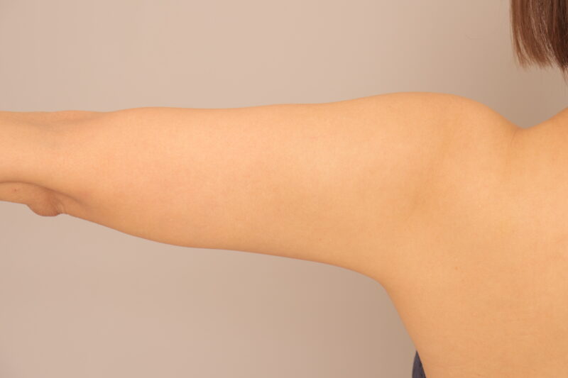 50代のモニター様の二の腕、肩の脂肪吸引1ヶ月後♡
