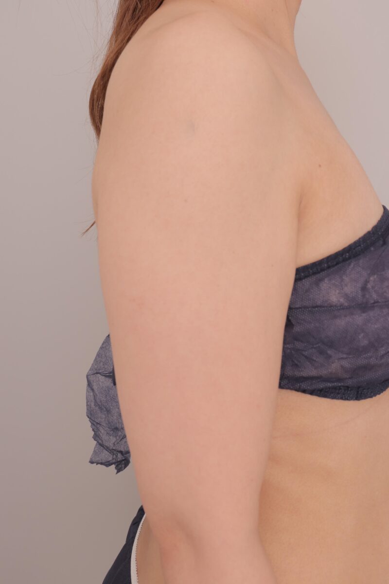 ベイザー脂肪吸引（1週間経過：35）の術前写真