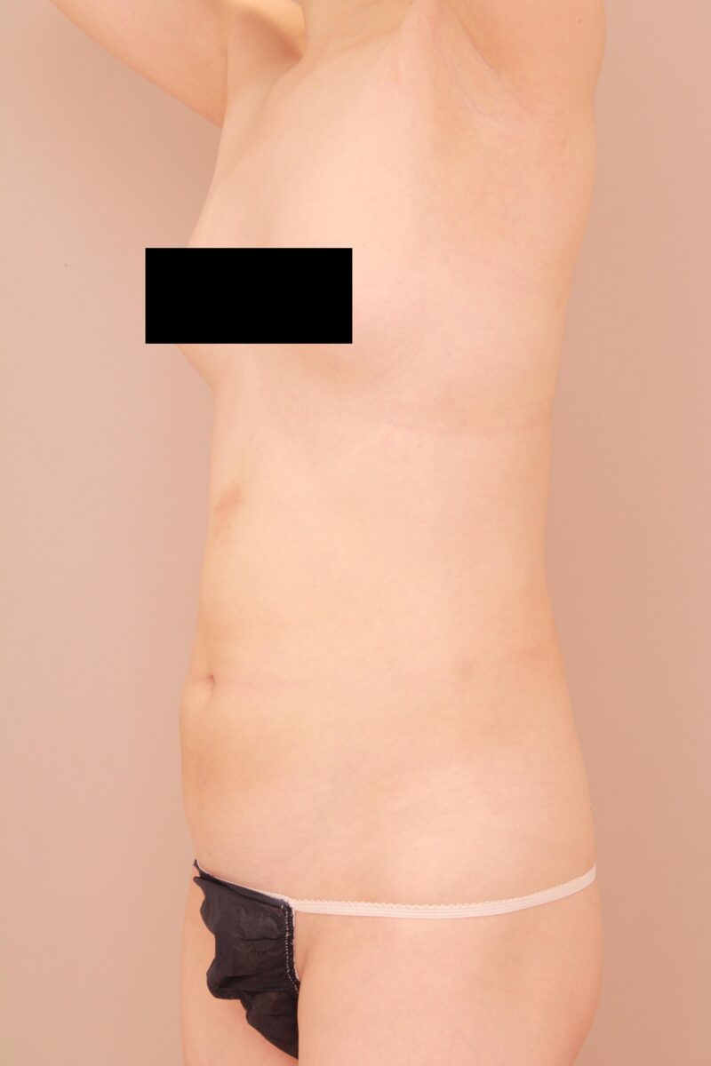 ベイザー脂肪吸引（6か月経過：33）の術前写真