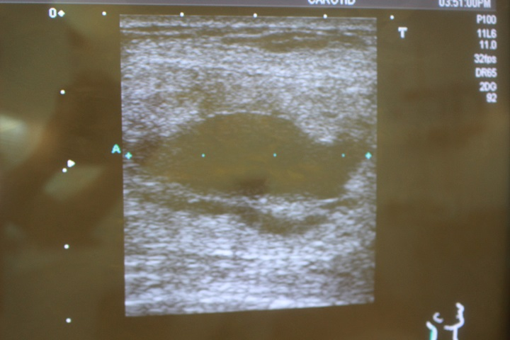 脂肪注入後のしこり除去