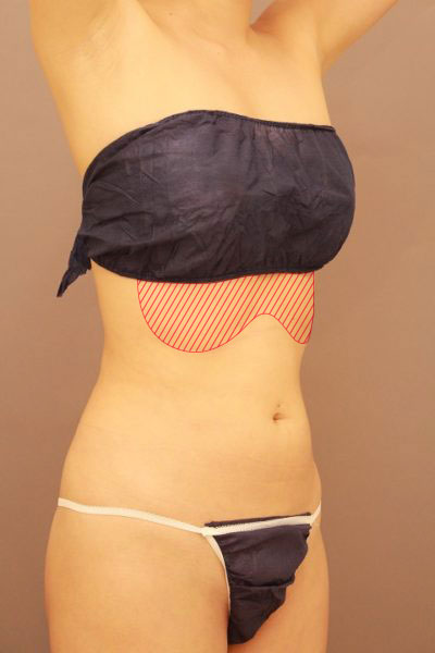 お腹の他院修正 1週間経過