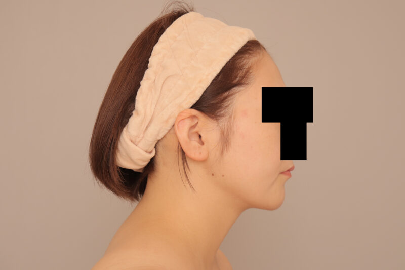 頬顎脂肪吸引でまっすます美人さんに♡モニター様半年後