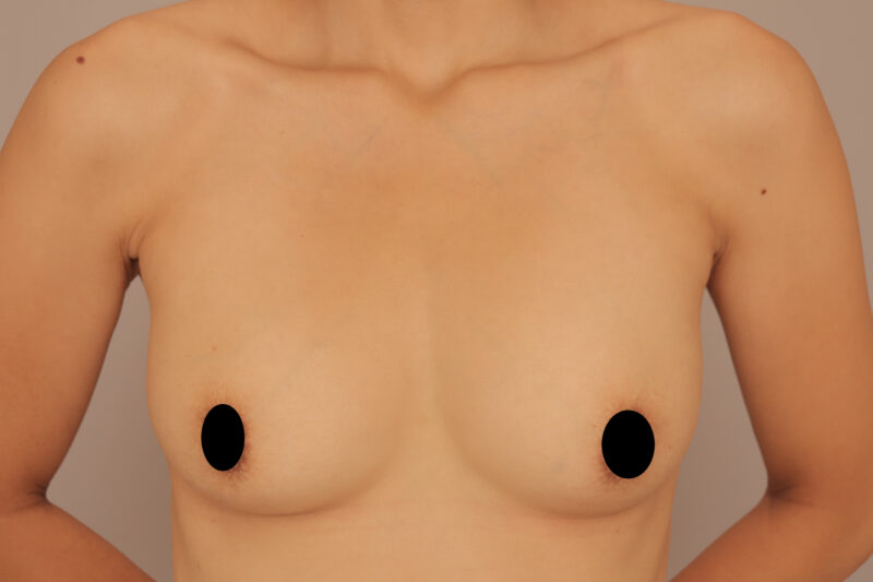 ママさんのコンデンスリッチ豊胸半年後