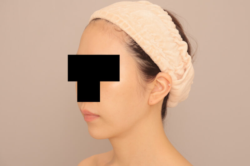 フェイスラインをシュッとさせて逆卵型の輪郭に♡