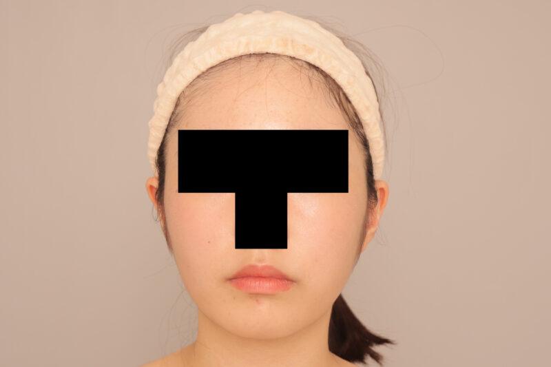 頬顎脂肪吸引でまっすます美人さんに♡