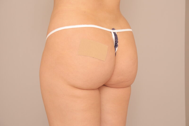 ブラジリアンバットリフトのモニター様3か月後♡目指せバービー体型!!