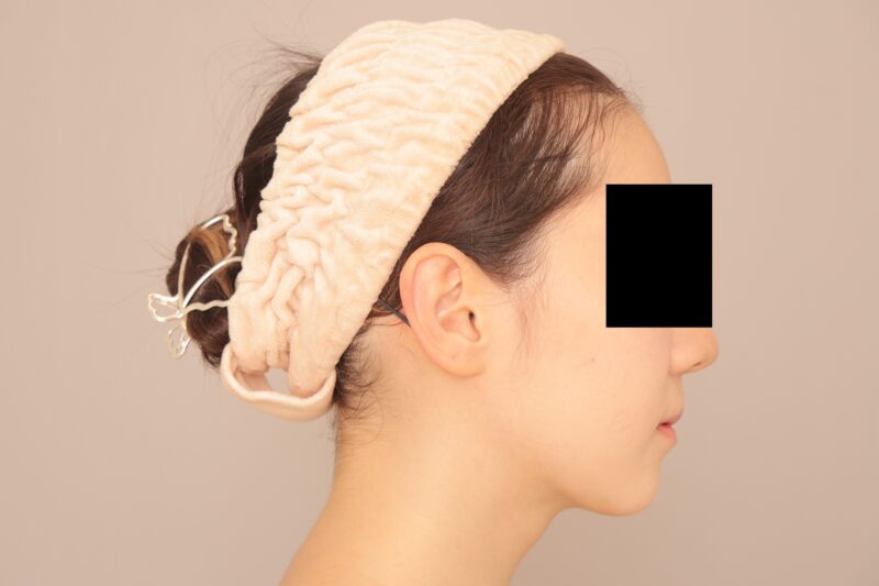 ベイザー脂肪吸引(3か月経過:20)の術後写真